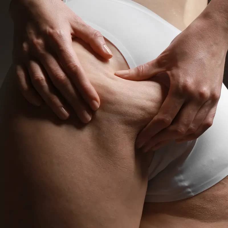 Protocolo Personalizado para Celulite